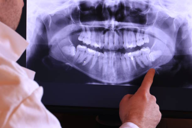 Best Emergency Wisdom Tooth Extraction in Biltmore, TN